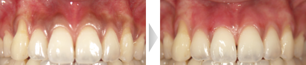 歯茎のホワイトニングの写真